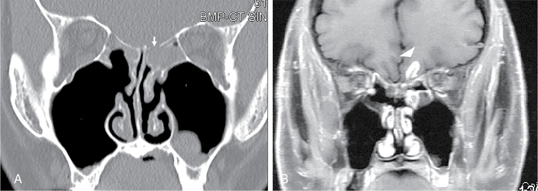 Fig. 12.1, Coronal sinus computed tomography ( A ) and T1-weighted postcontrast magnetic resonance imaging ( B ) show classic ethmoid roof injury after endoscopic sinus surgery. A left ethmoid roof bony defect (arrow) can be see with associated intracranial injury (arrowhead) .