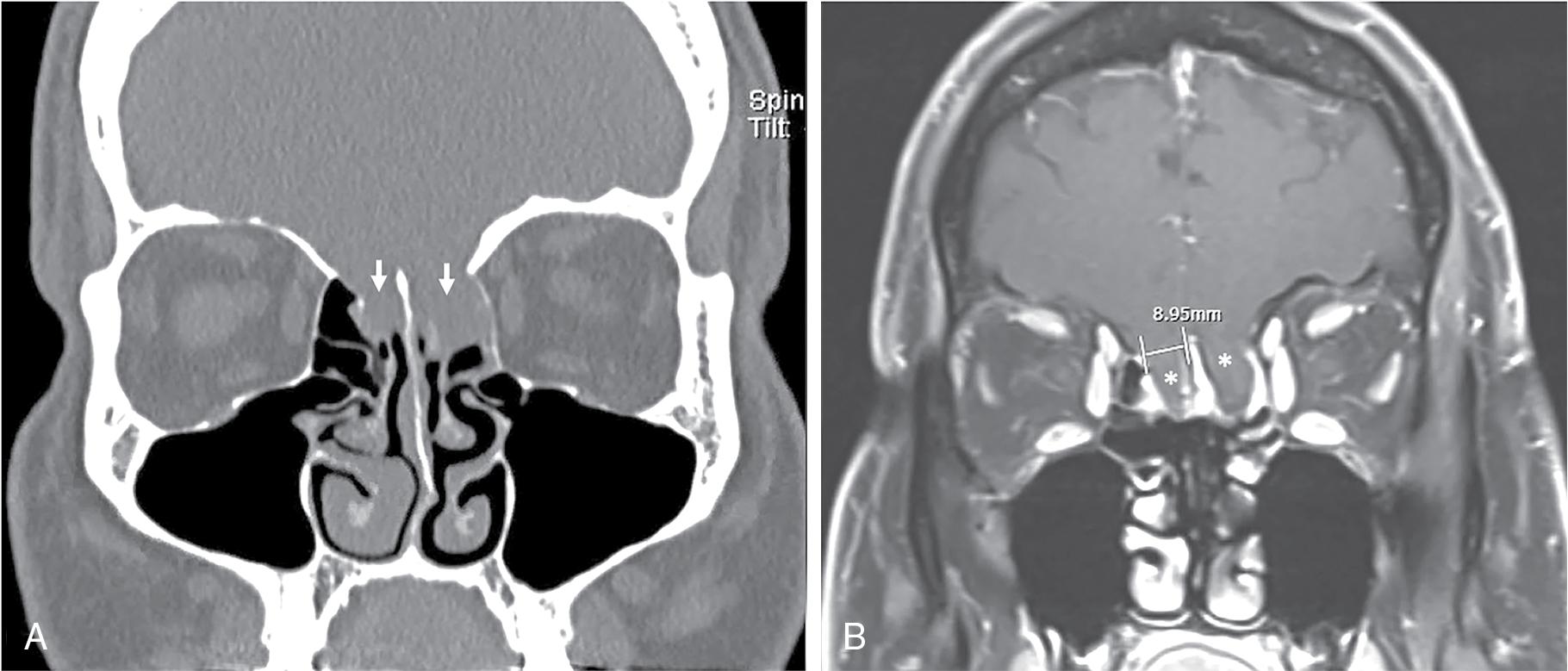 Fig. 12.2, Coronal sinus computed tomography ( A ) and T1-weighted postcontrast magnetic resonance imaging ( B ) show an atypical injury to the cribriform and ethmoid roof with bilateral ethmoid skull base bony defects (arrows) and bilateral meningoencephaloceles (stars) in setting of iatrogenic cerebrospinal fluid rhinorrhea after septoplasty