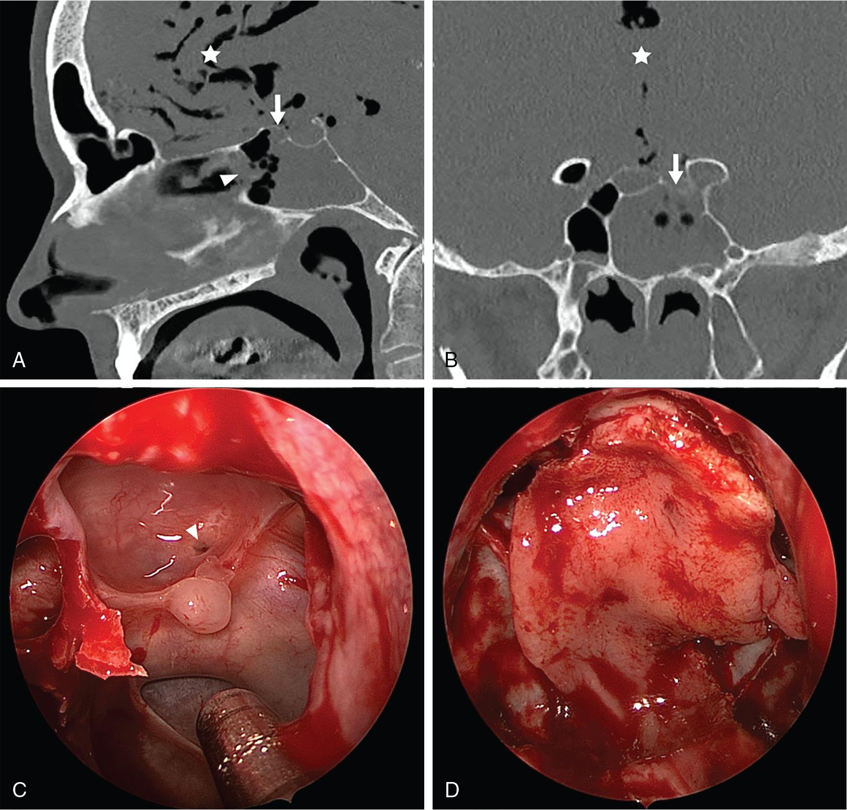 Fig. 12.3, Sagittal ( A ) and coronal ( B ) reconstructions from noncontrast sinus computed tomography demonstrate a large amount of pneumocephalus localizing to the interhemispheric region in the anterior cranial fossa (star). An area of bone thinning and irregularity in the planum sphenoidale just anterior to the sella and to the left of midline is suspicious for the site of breach (arrow). Note the widened left sphenoid ostium after balloon dilation (arrowhead). C, Endoscopic view of iatrogenic planum defect thought to be caused by a balloon guidewire. D, Endoscopic view after preparation of the defect site with removal of the surrounding mucosa and repair with a pedicled nasoseptal flap.