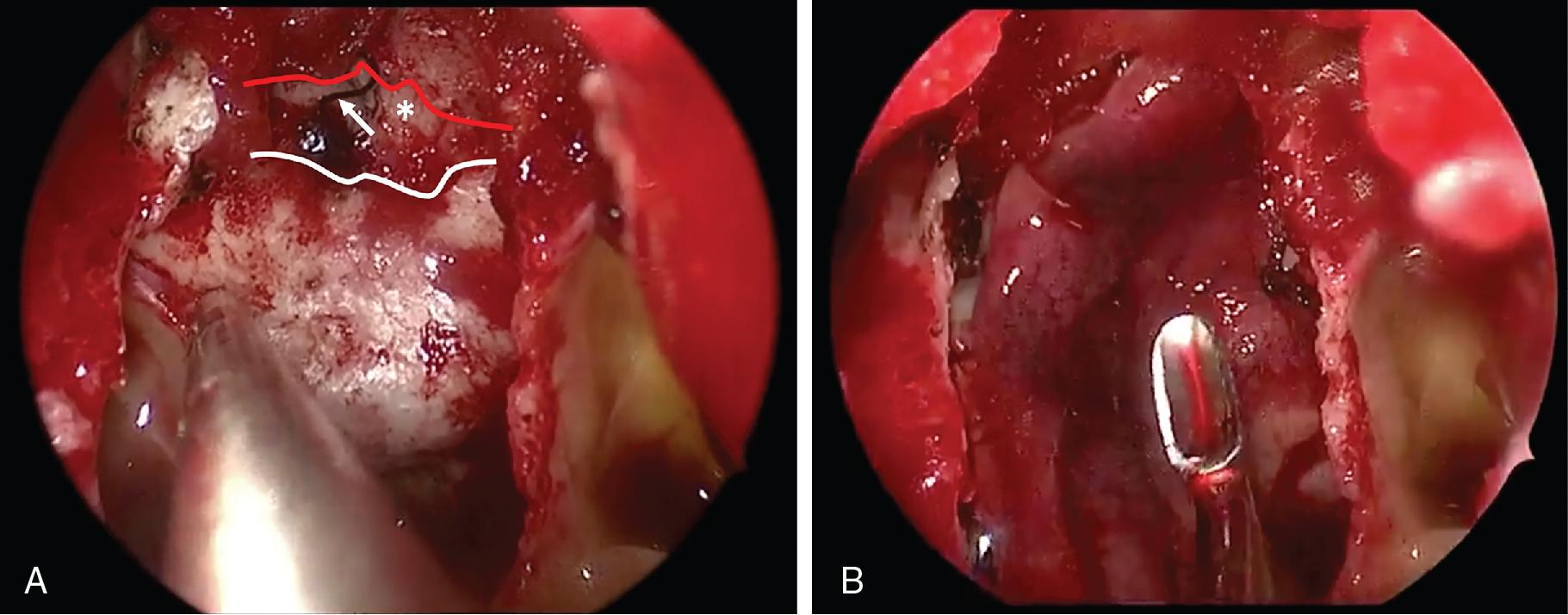 Fig. 12.4, A, Endoscopic view of the sphenoid sinus shows a postoperative iatrogenic planum sphenoidale leak after bicoronal frontal craniotomy and pericranial flap reconstruction for a large olfactory cleft meningioma. Dehisced stitch (arrow) with frontal lobe exposed (star) visualized between posterior planum bone (white line) and edge of the pericranial flap (red line). B, Endoscopic view after preparation of the defect site and repair with a right nasoseptal flap.