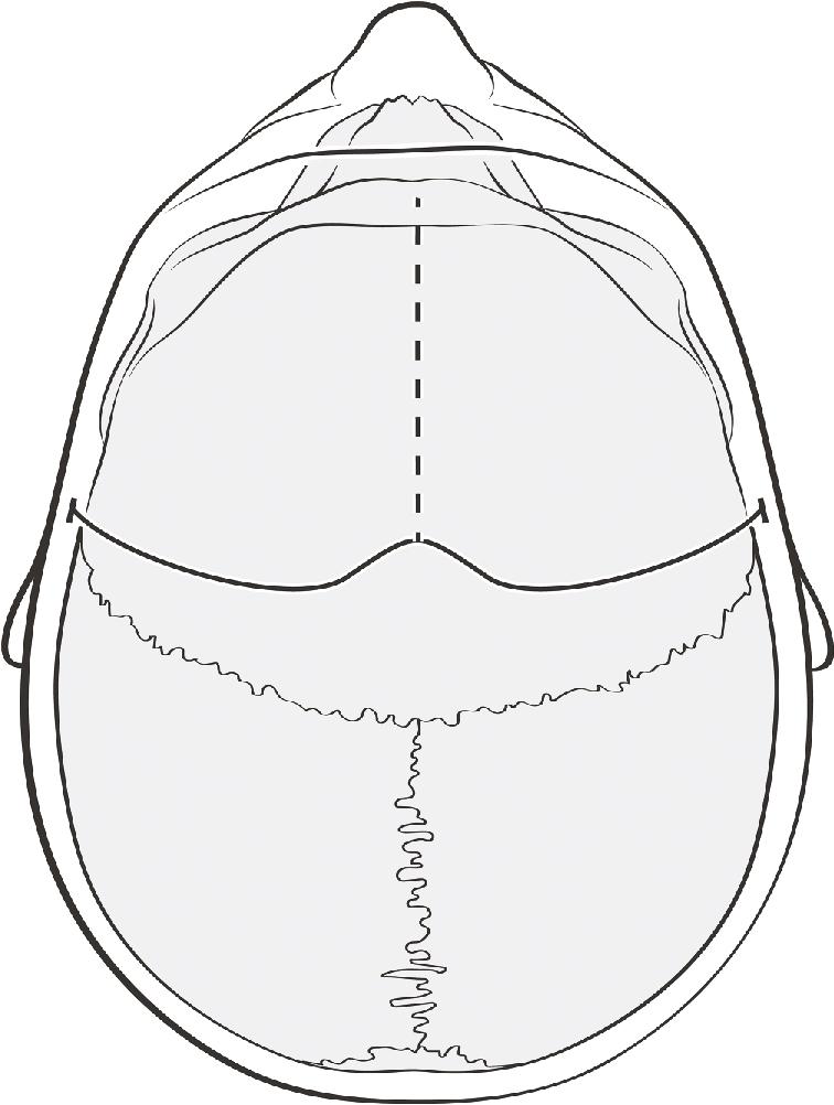 Fig. 13.1, Schematic demonstrates the position of bilateral “Souttar” craniotomy incision.