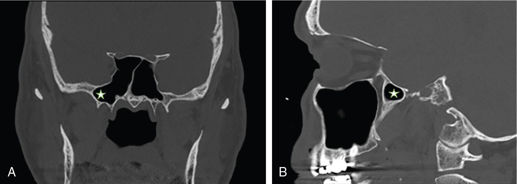 Fig. 22.1, Coronal ( A ) and sagittal ( B ) computed tomography (CT) images of a pneumatized lateral recess of the sphenoid sinus (star).