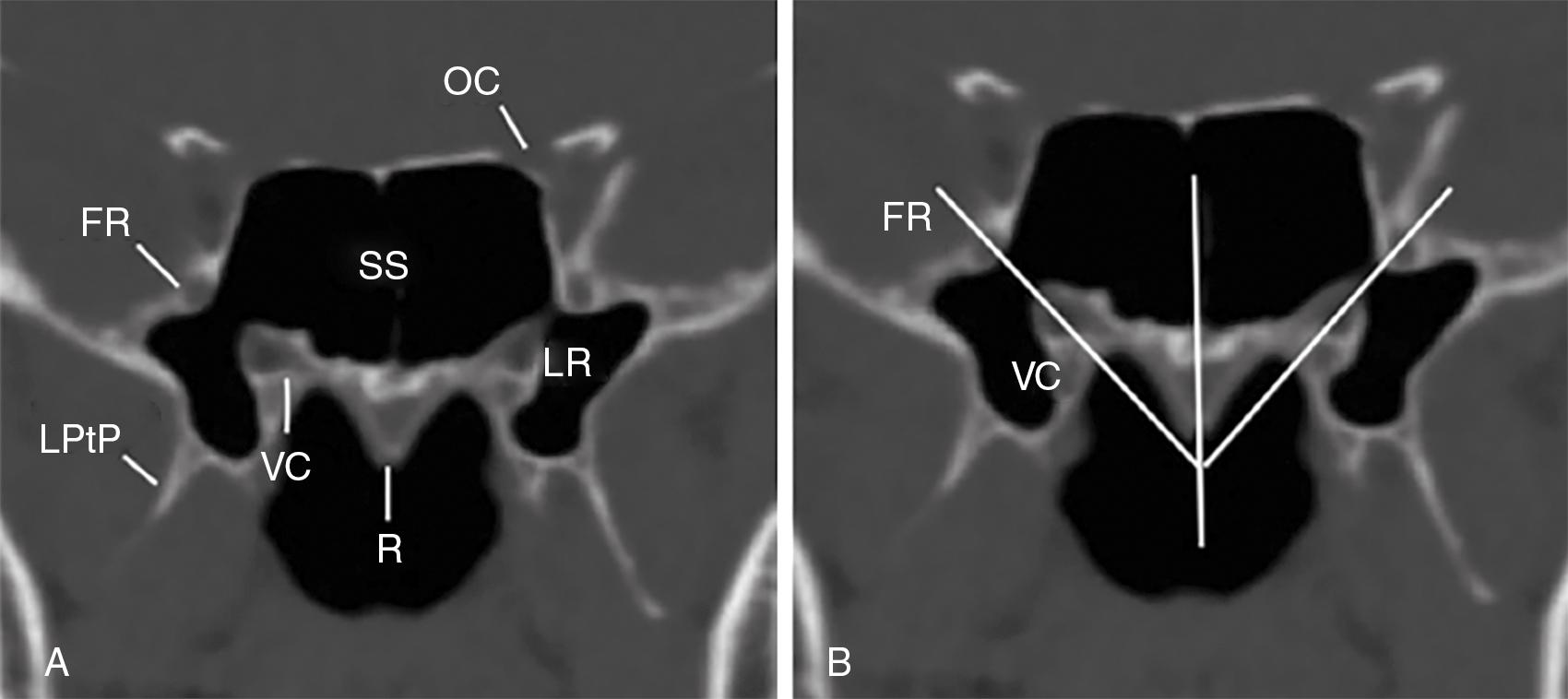 Fig. 22.2, ( A ) Coronal computed tomography (CT) scan at which the vidian canal and foramen rotundum are visualized. ( B ) Angle of the VC to FR (V-R line) was measured between an imaginary midline vertical to the rostrum and an imaginary line connecting VC and FR. The volume of the lateral recess (LR) of the sphenoid as defined by the V-R line medially was measured.