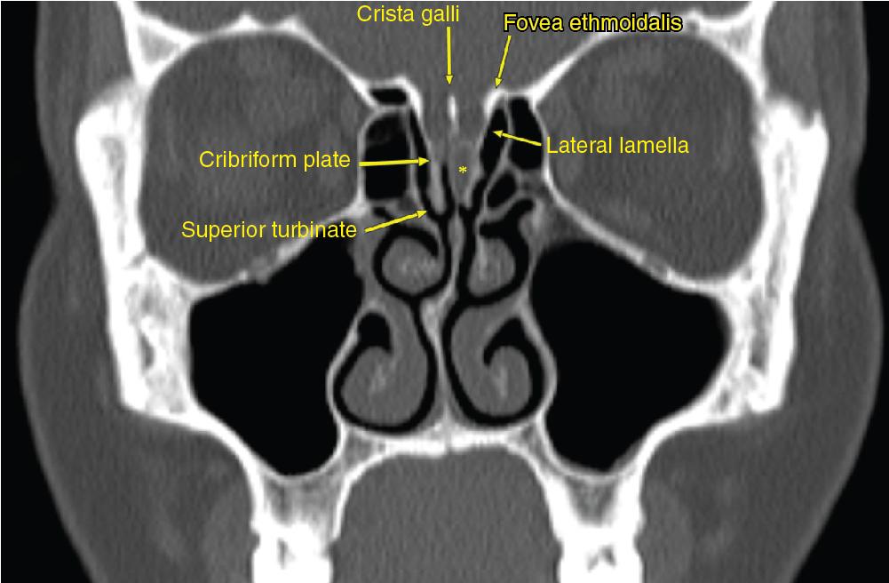 Fig. 21.1, Coronal computed tomography imaging of the sinus demonstrating pertinent anterior skull base anatomy, including the olfactory fossa, fovea ethmoidalis, cribriform plate, lateral lamella, crista galli, and superior turbinate. The asterisk represents a unilateral opacification of the olfactory cleft suspicious for encephalocele.