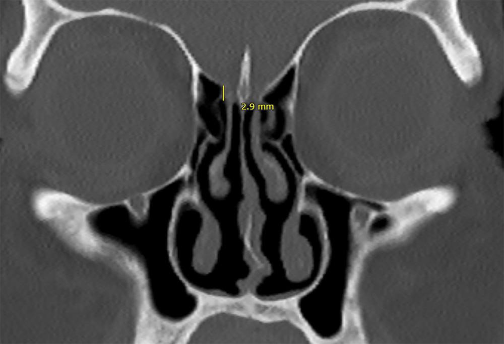 Fig. 21.2, Coronal computed tomography imaging of the demonstrating Keros type 1, olfactory fossa with a depth of 1 to 3 mm.