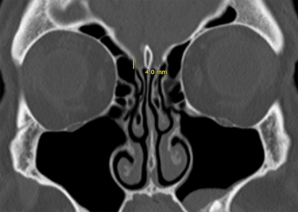 Fig. 21.3, Coronal computed tomography imaging of the demonstrating Keros type 2, olfactory fossa with a depth of 4 to 7 mm.