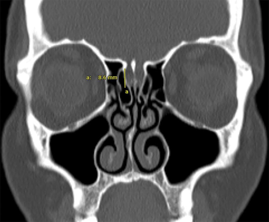 Fig. 21.4, Coronal computed tomography imaging of the demonstrating Keros type 3, olfactory fossa with a depth of 8 to 16 mm.