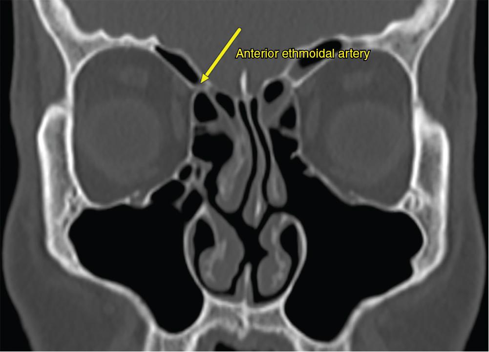 Fig. 21.5, Coronal computed tomography imaging of the demonstrating the position of the anterior ethmoidal artery.