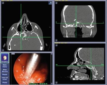 Figure 3.2, Sphenoidal sinus fungus ball.