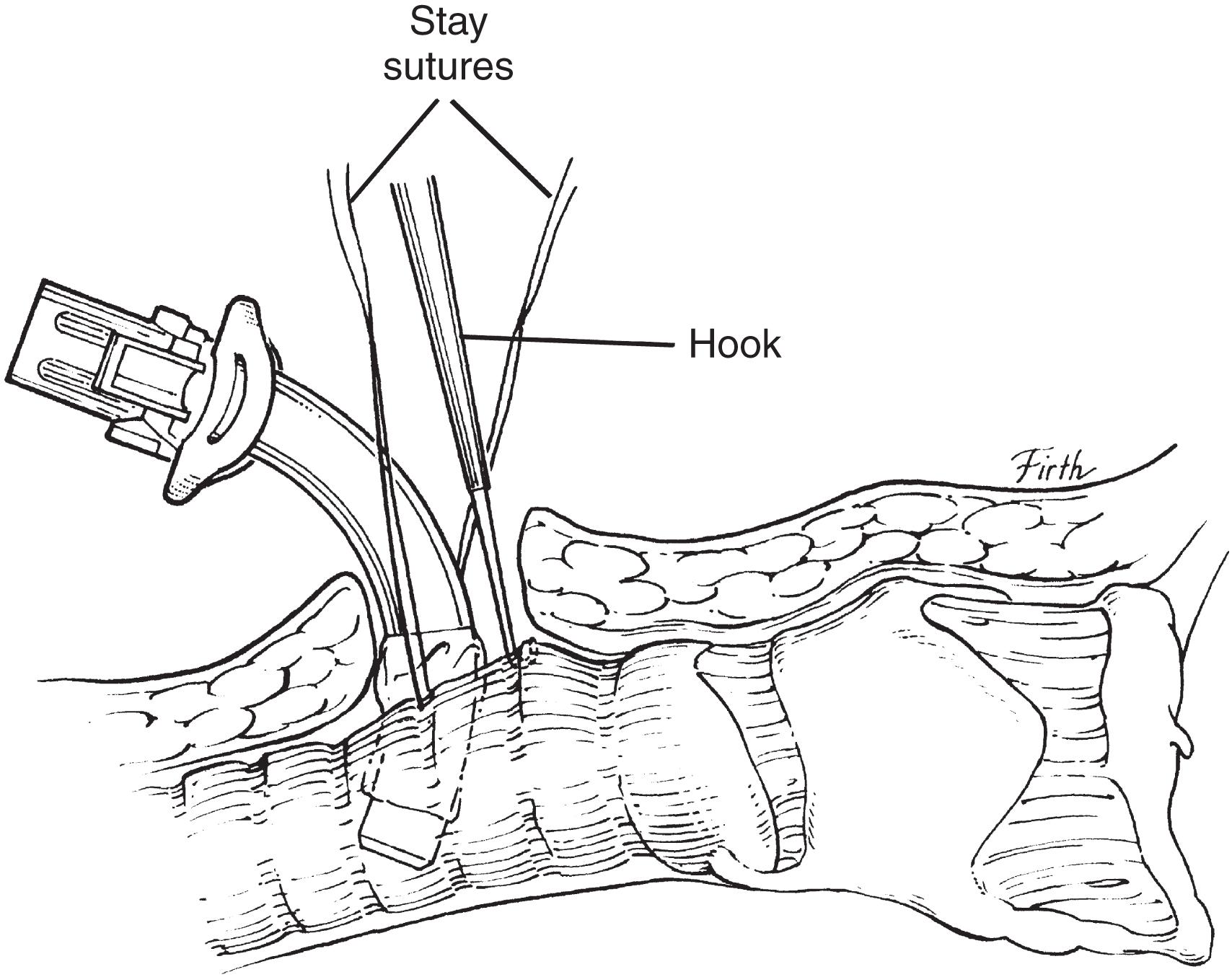 FIGURE 2, Tracheostomy tube insertion.