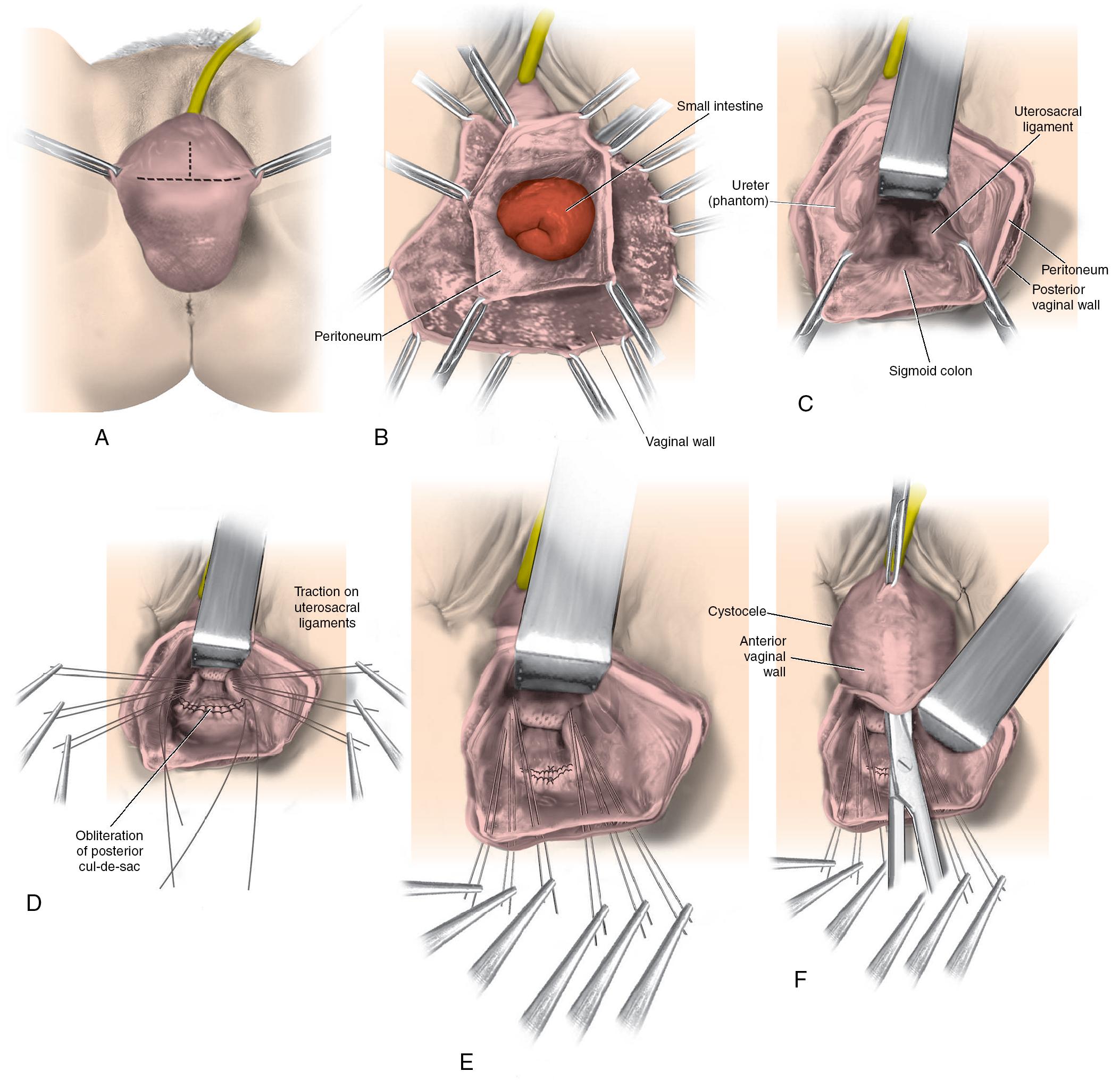 Fig. 21.3, Technique for uterosacral ligament suspension of the vaginal vault. A , The most prominent portion of the prolapsed vaginal vault is grasped with Allis clamps. B , The vaginal wall is opened, and the enterocele sac is identified and entered. C , The bowel is packed high up into the pelvis using laparotomy sponges. The retractor lifts the sponges up out of the lower pelvis, thus completely exposing the cul-de-sac. When appropriate downward traction is applied on the uterosacral ligaments with an Allis clamp, the uterosacral ligaments are easily palpated bilaterally. D , Delayed absorbable sutures are passed through the uppermost portion of the uterosacral ligaments (proximal to the spines) on each side and are individually tagged. E , Each end of the previously passed sutures is brought out through the posterior peritoneum and the posterior vaginal wall (or separate ends passed through the anterior and posterior vaginal walls, not shown). A free needle is used to pass both ends of these delayed absorbable sutures through the full thickness of the vaginal wall. F , The anterior colporrhaphy is begun by initiating a dissection between the prolapsed bladder and the anterior vaginal wall. G , The anterior colporrhaphy has been completed. H , The vagina has been appropriately trimmed and closed with interrupted or continuous delayed absorbable sutures. After closing the vagina, the delayed absorbable sutures that were previously brought out through the full thickness of the posterior (or anterior and posterior) vaginal wall(s) are tied, thereby elevating the prolapsed vaginal vault high up into the hollow of the sacrum.