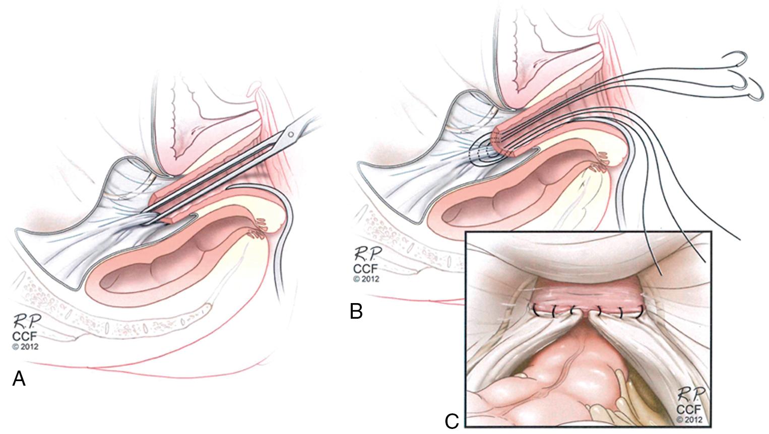 Fig. 21.4, Uterosacral ligament suspension. A , The uterosacral ligament proximal to the level of the ischial spine is grasped with an Allis clamp. B , Three sutures are placed through the ipsilateral uterosacral ligament and then through the vaginal apex. C , Sutures are placed bilaterally and tied, suspending the apex.