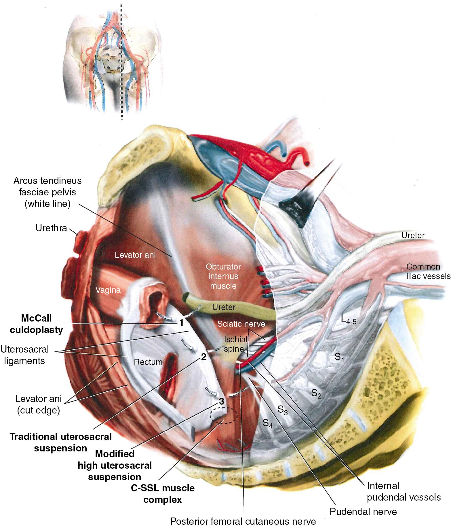 Fig. 21.2, Cross-section of the pelvic floor demonstrating intraperitoneal placement of sutures for (1) McCall culdoplasty, (2) traditional reattachment of the uterosacral ligaments to the vaginal cuff after hysterectomy, and (3) uterosacral ligament suspension, with sutures placed through the ligaments proximal to the ischial spines. Note that uterosacral ligament suspension may involve passage of the suture through the coccygeus muscle–sacrospinous ligament ( C-SSL ) complex, because a portion of the uterosacral ligament inserts into this structure.