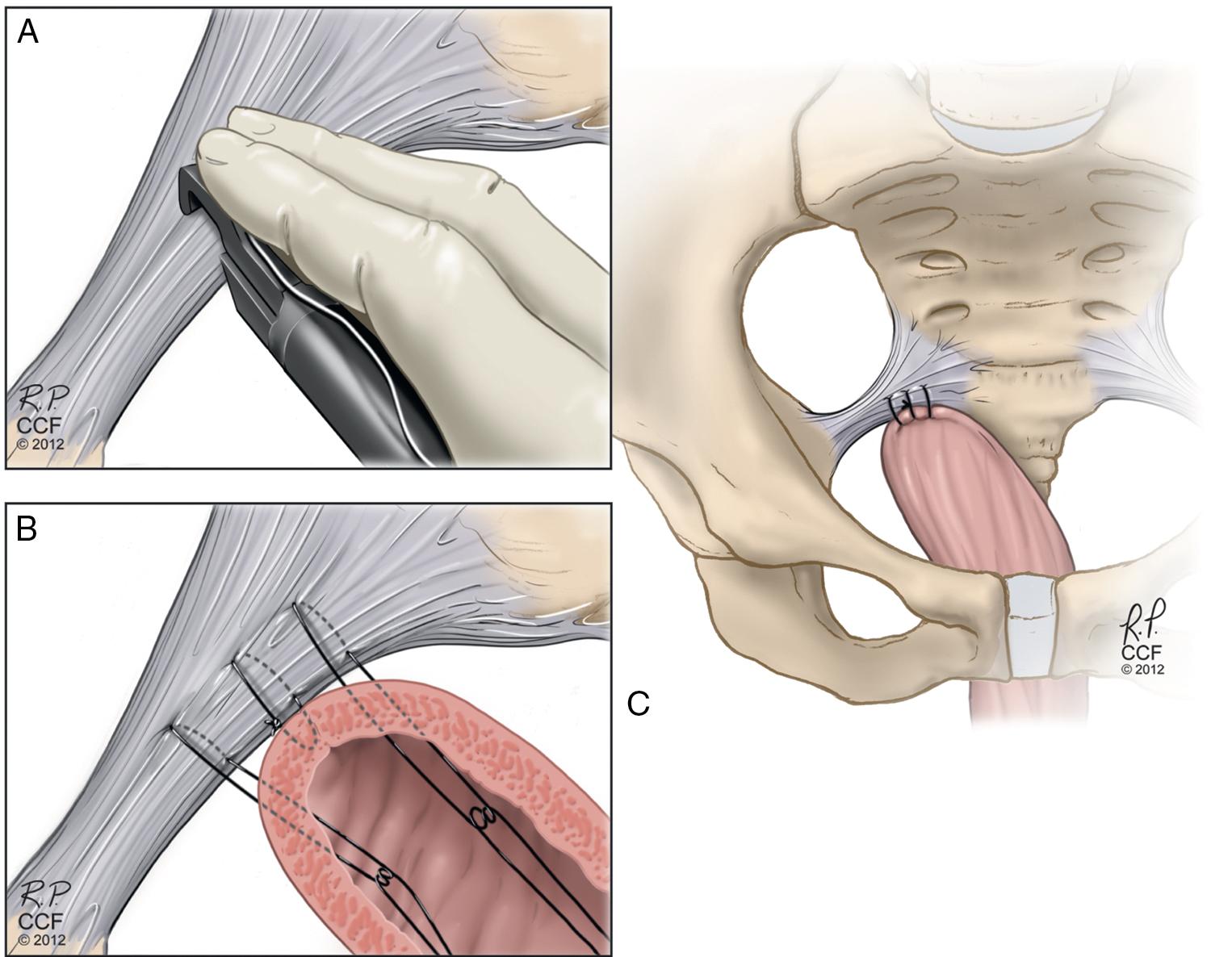 Fig. 21.6, Sacrospinous ligament suspension. A , Placement of the suture-capturing device with suture against the coccygeus muscle–sacrospinous ligament complex (C-SSL). Note that needle tip is passed downward from above. B , Three sutures are placed through the C-SSL; in this figure, the middle suture is nonabsorbable, so it is passed through the muscularis, and the knot buried. C , Final attachment of the vagina to the C-SSL.