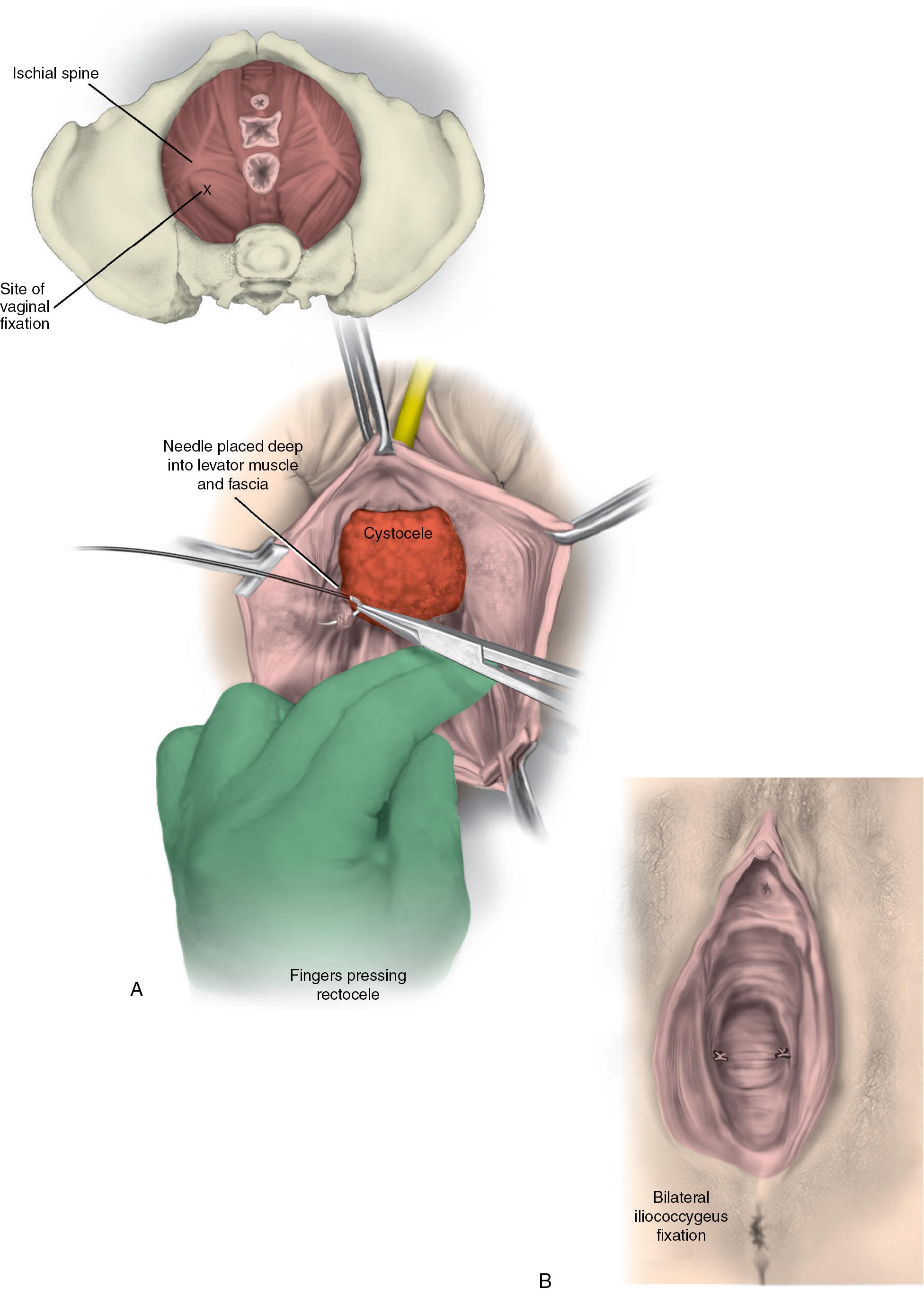 Fig. 21.7, Iliococcygeus fascia suspension. A , With the surgeon’s finger pressing the rectum downward, the right iliococcygeus fascia suture is placed. Approximate location of the iliococcygeus fascia sutures ( inset ). B , Bilateral iliococcygeus fascia suspension.