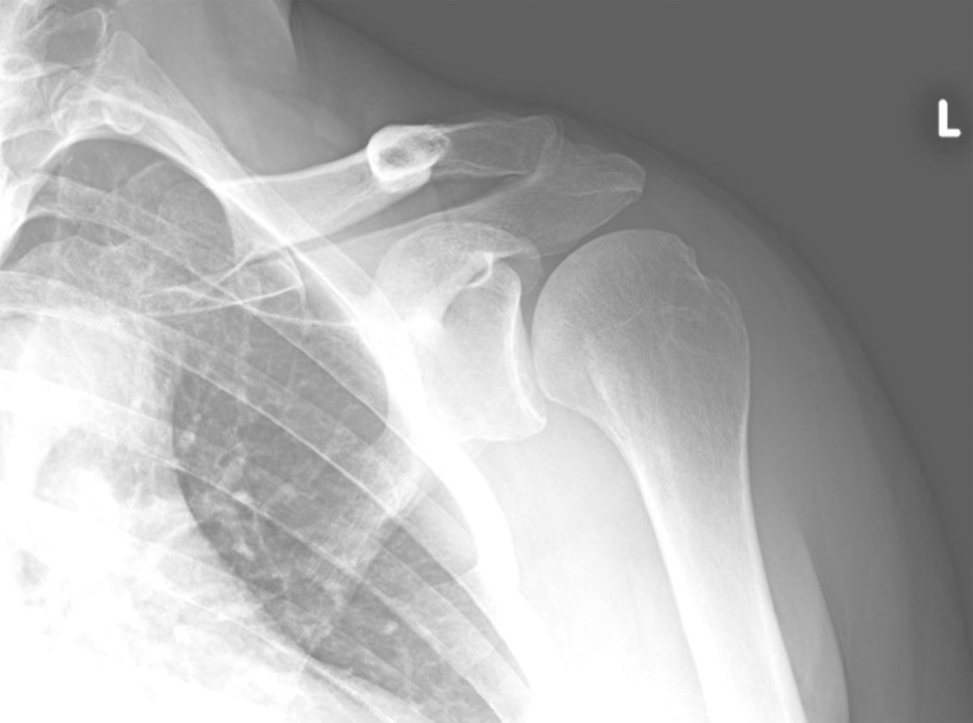 Fig. 6.1, An anteroposterior radiograph demonstrating a Hill–Sachs lesion.