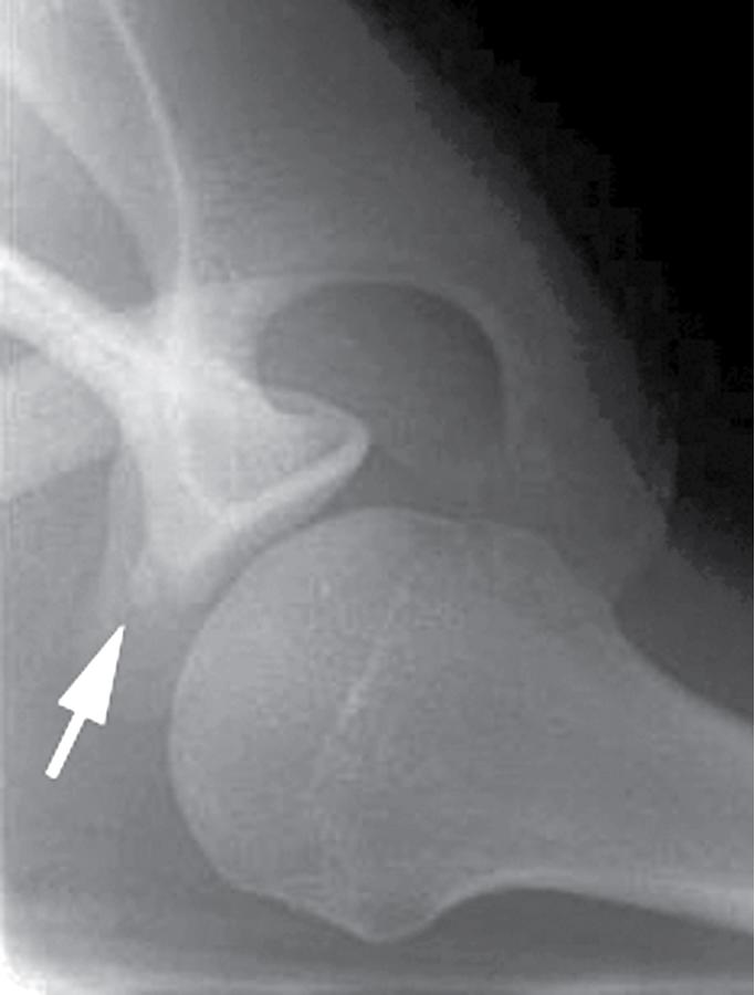 Fig. 6.2, A West Point axillary radiograph was used to evaluate the glenoid. This radiograph reveals an avulsion of the anteroinferior corner of the glenoid (bony Bankart lesion; arrow ).