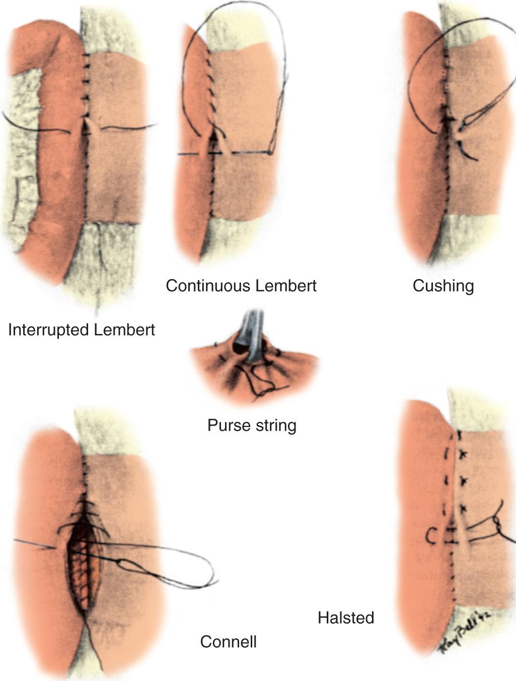 FIGURE 85.1, Intestinal suture methods.