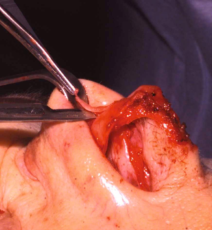 Figure 14-2, Cephalic trim of the lower lateral cartilage. Before beginning suture techniques on the nasal tip, a cephalic trim of the lateral crus is almost always needed in the primary rhinoplasty because there is almost always some tip bulbosity. At least 6 mm of lateral crus is maintained. This makes it easier to reshape and reposition the tip using suture techniques, preserving the integrity of the lower lateral cartilage both aesthetically and functionally.