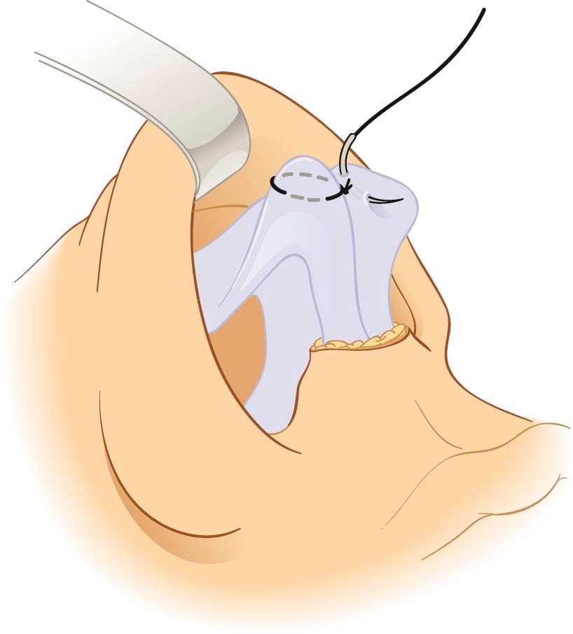 Figure 14-3, Schematic depiction of the hemitransdomal suture. The needle enters the cartilages parallel to the surface of the dome. The suture is usually placed 2 to 3 mm below the dome level. The lower the suture is placed from the dome, the more it tends to evert the lateral crus. Also, the larger the purchase of the cephalic dome, the more the dome width is reduced.