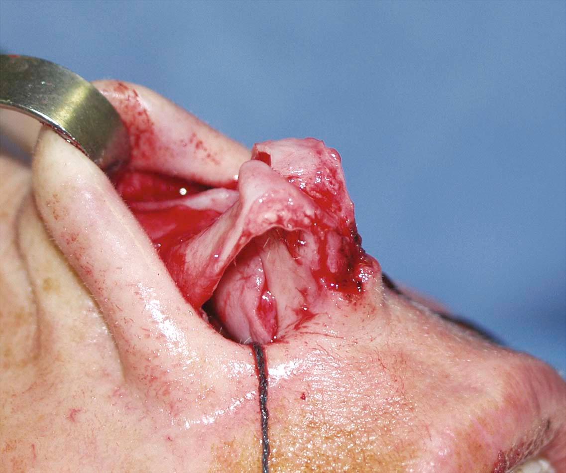 Figure 14-4, Intraoperative effect of the hemitransdomal suture. The cephalic aspect of the dome is narrowed. The caudal part of the dome is minimally narrowed if at all. Also note that the caudal border of the lateral crus is everted somewhat (or at least not inverted). Consequently, the caudal border of the rim is not forced to become concave.