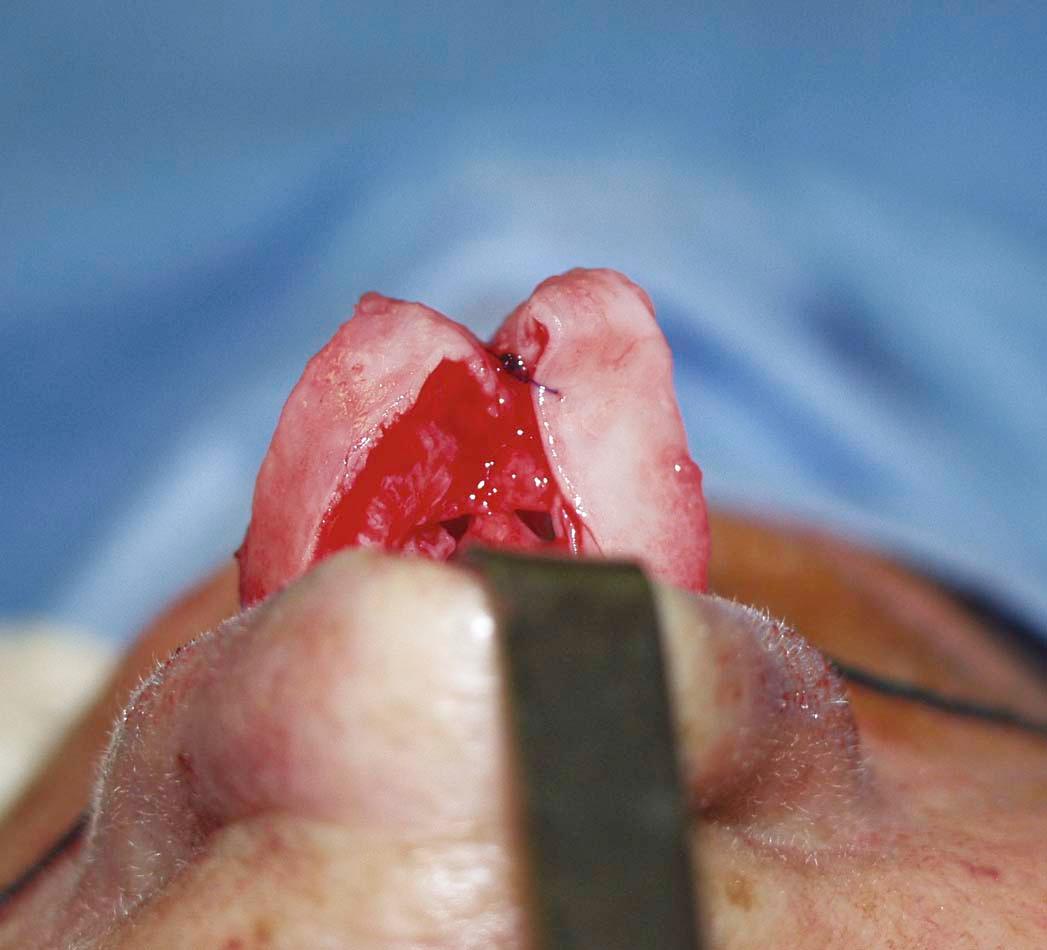 Figure 14-5, Hemitransdomal suture. View from head of bed.