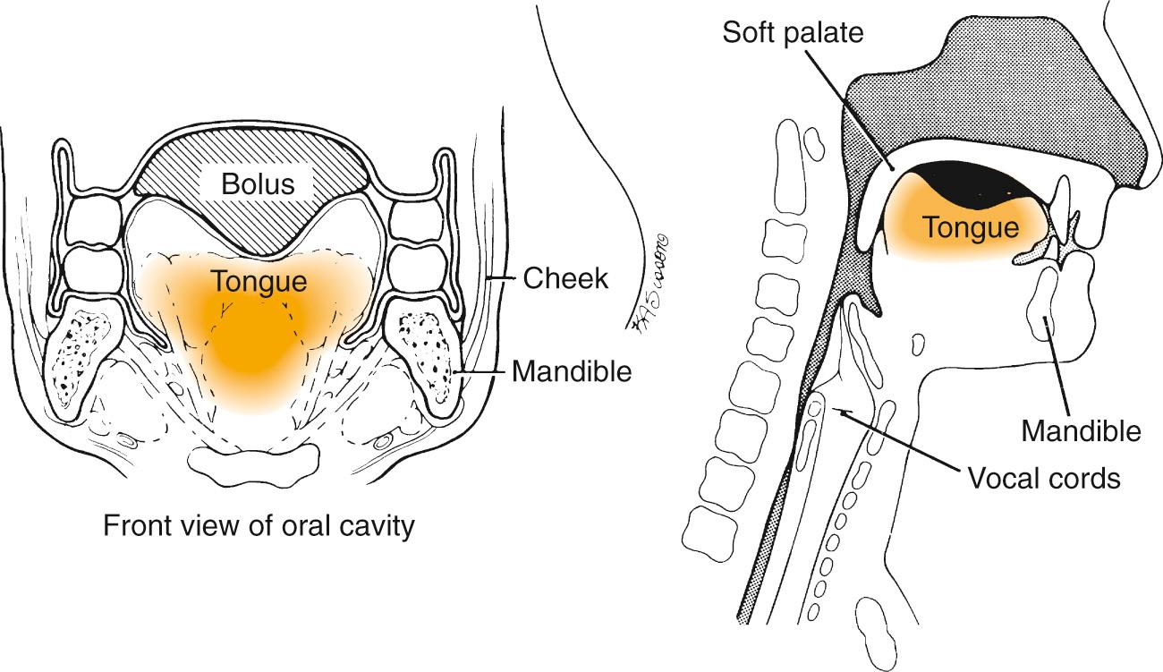 Fig. 99.1, The anterior and lateral views of the tongue position in holding a bolus immediately before initiating the oral stage of the swallow.