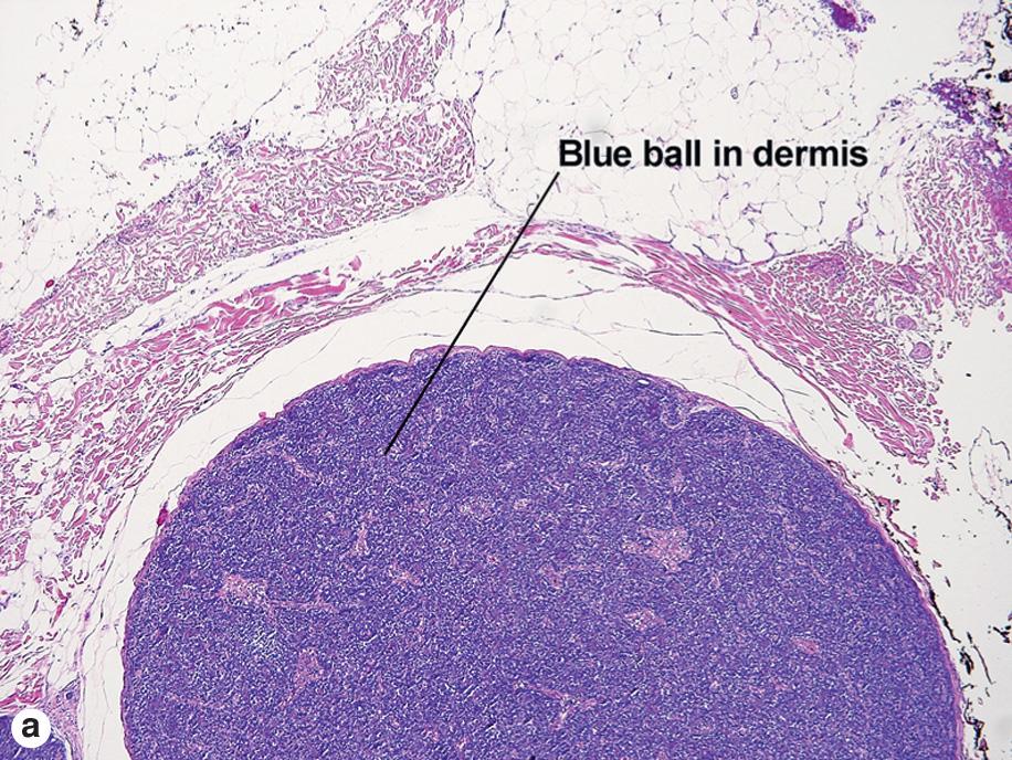 Fig. 5.2, Spiradenoma