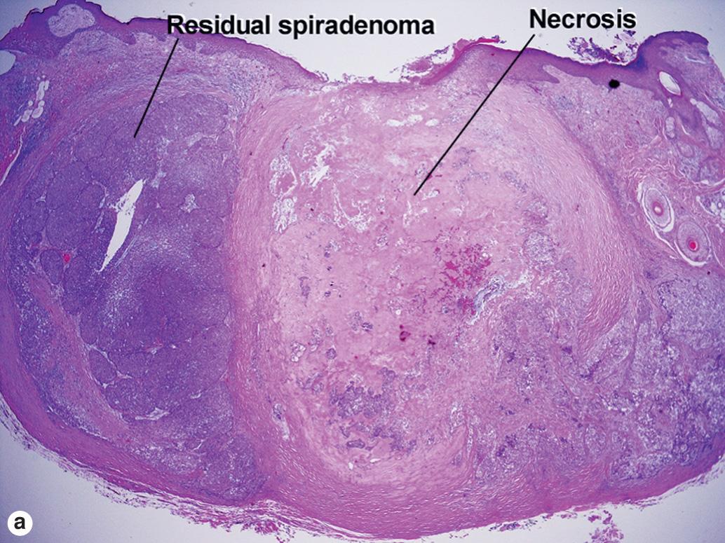 Fig. 5.3, Spiradenocarcinoma