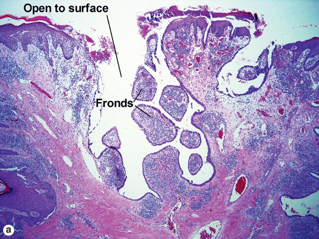 Fig. 5.4, Syringocystadenoma papilliferum