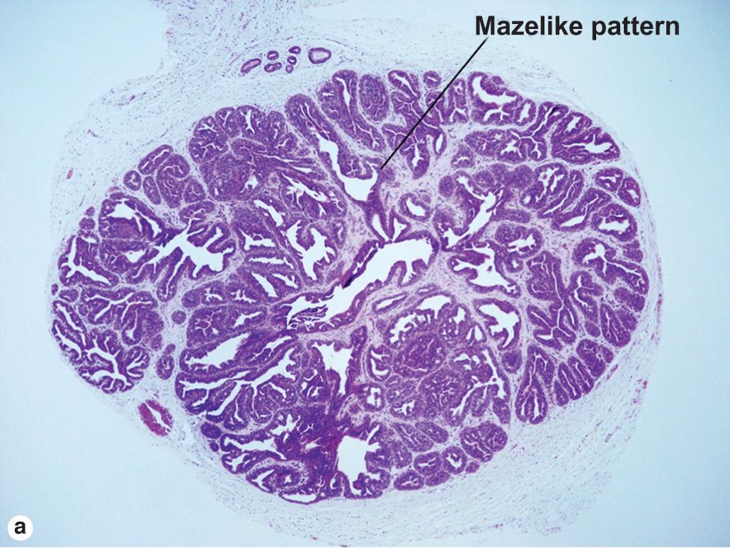 Fig. 5.5, Hidradenoma papilliferum