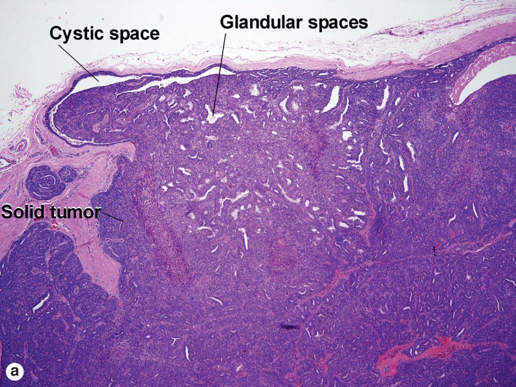 Sweat Gland Neoplasms Clinical Tree