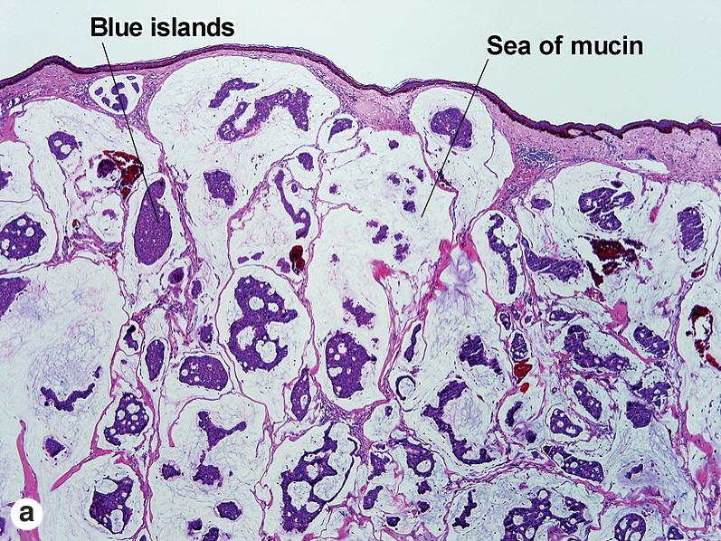 Fig. 5.7, Mucinous carcinoma