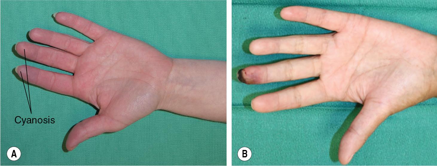 FIGURE 96.1, (A–B) Clinical indications for sympathectomy: refractory symptoms and frank necrosis despite maximal nonsurgical interventions.