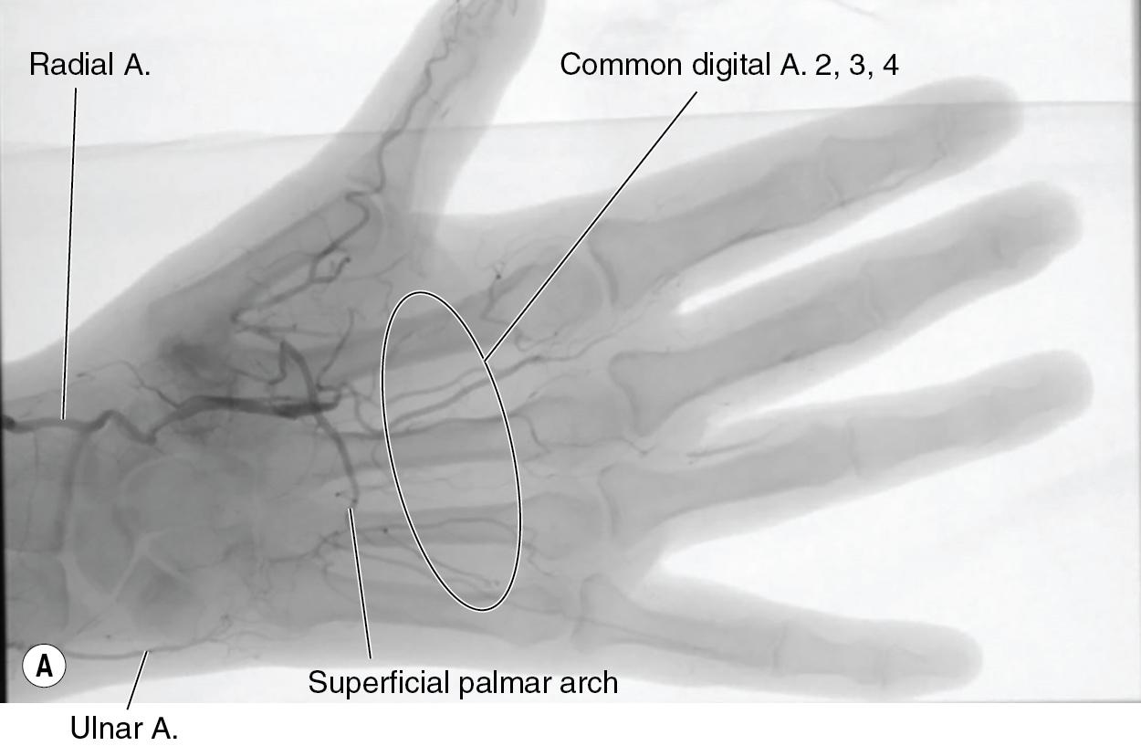 FIGURE 96.2, (A–B) Profound vaso-occlusion of ulnar artery, palmar arch, and common digital arteries to index, long, ring, and small fingers on angiogram.