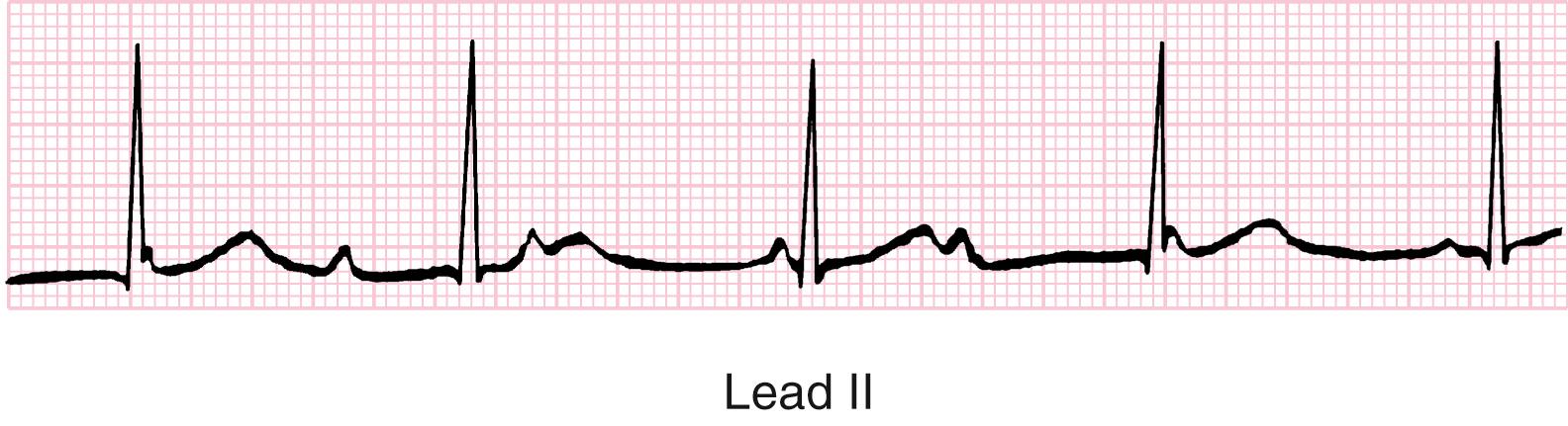 Fig. 7.2, Congenital complete atrioventricular (AV) block. The ventricular rate is regular at 53 beats/min. The atrial rate is somewhat variable, from 65 to 95 beats/min, and completely dissociated from the ventricle. The QRS morphology is normal, which is common in congenital complete AV block.