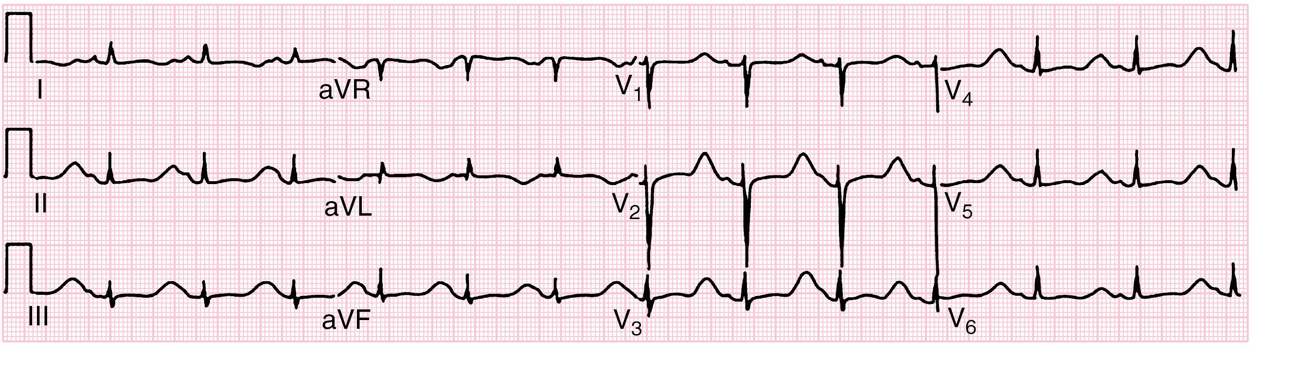 Fig. 7.3, An ECG showing a QT interval of 640 milliseconds in a patient with LQT1 syndrome, with the terminal portion of the T wave merging with the P wave.