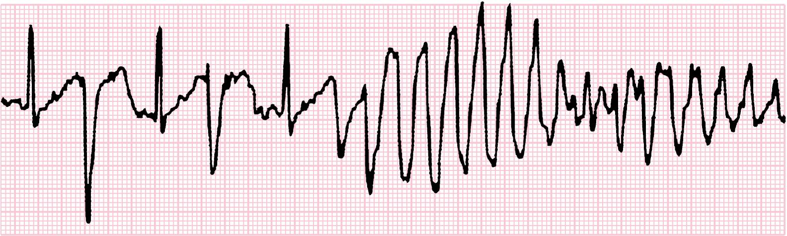 Fig. 7.4, Episode of torsades de pointes in a patient with long QT syndrome.