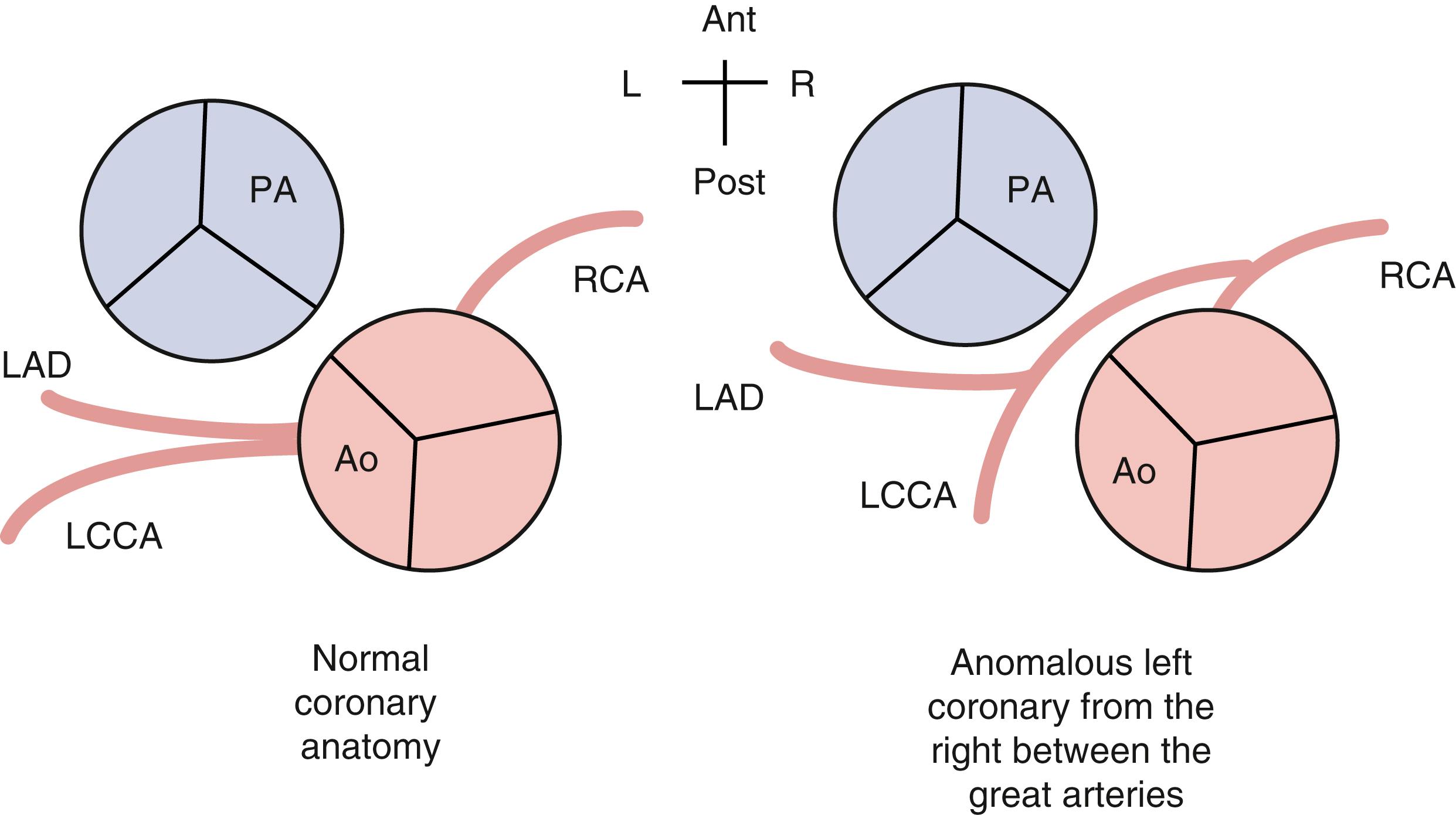 Fig. 7.5, Coronary artery anomalies associated with sudden cardiac death. Ant, anterior; Ao, aorta; L, left; LAD, left anterior descending coronary artery; LCCA, left circumflex coronary artery; PA, pulmonary artery; Post, posterior; R, right; RCA, right coronary artery.