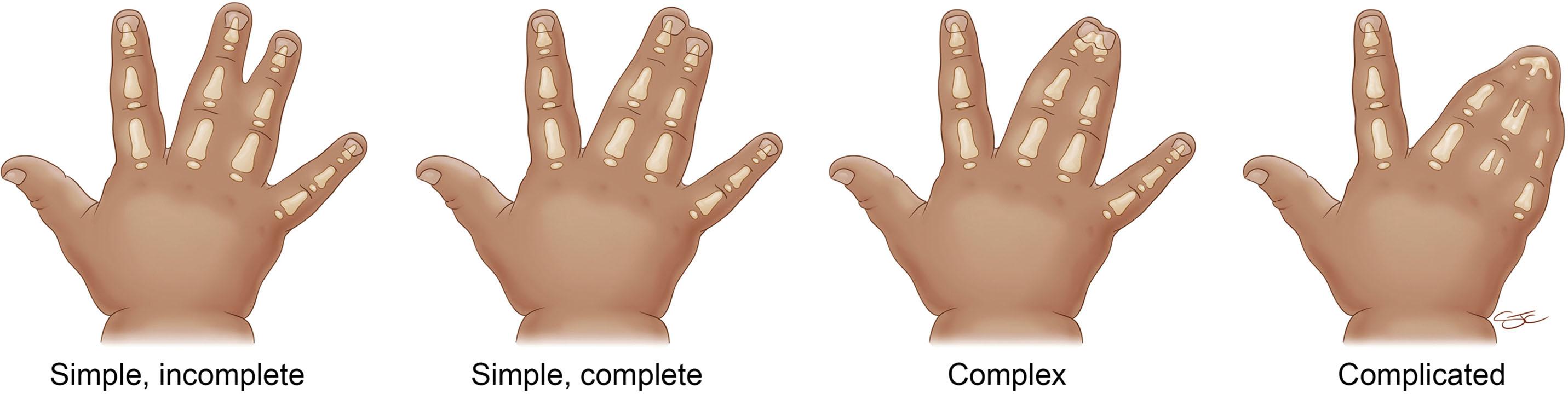 Fig. 17.1, Types of Syndactyly.