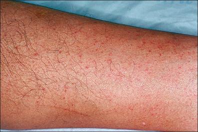 Figure 1-3, Erythematous macules associated with West Nile virus infection.