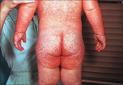 Figure 1-5, Erythematous macules of measles on day 3 of the rash.