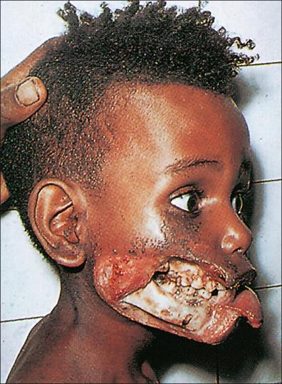 Figure 1-6, Cancrum oris (Noma) of the facial region is associated with malnutrition and poor oral hygiene in the presence of Treponema vincentii plus Gram-negative bacteria following a systemic disease such as measles.