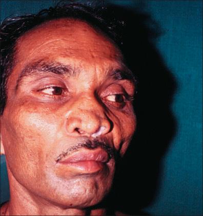 Figure 1-7, Saddle-nose deformity due to tertiary syphilis in a human immunodeficiency virus (HIV)-seropositive man in India.