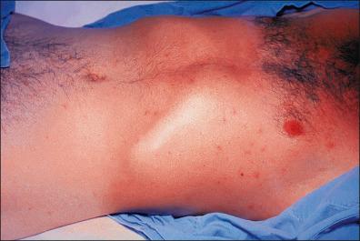 Figure 1-9, Rose spots in a patient with typhoid fever due to Salmonella typhi .