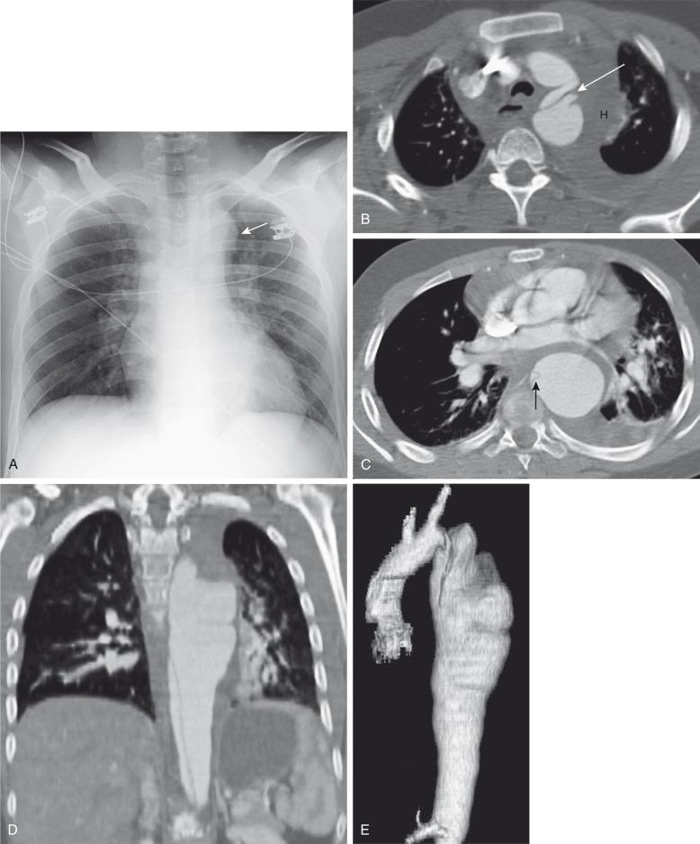 Figure 78.3, Ehlers – Danlos syndrome.