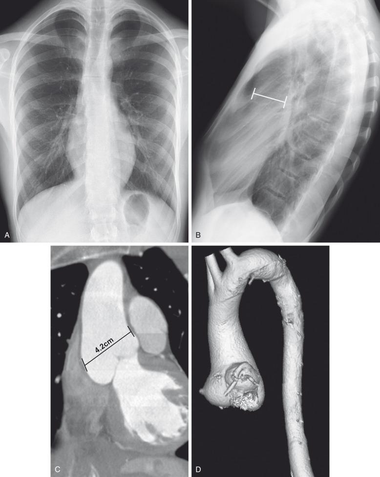 Figure 78.4, Marfan syndrome in an 18-year-old boy.