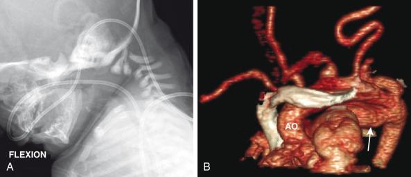 Figure 78.5, Infant with Loeys – Dietz syndrome.