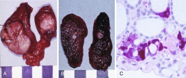 Fig. 27.1, Hereditary C-cell disease in the era of clinical (A) , biochemical (B) , and molecular (C) diagnosis.