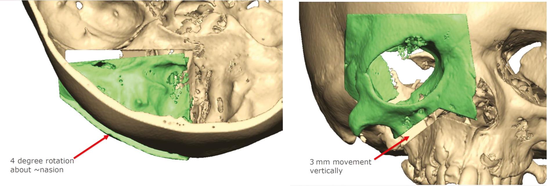 Fig. 10.1, Computer-assisted surgical planning for translational and rotational movements of the orbit after box osteotomy.